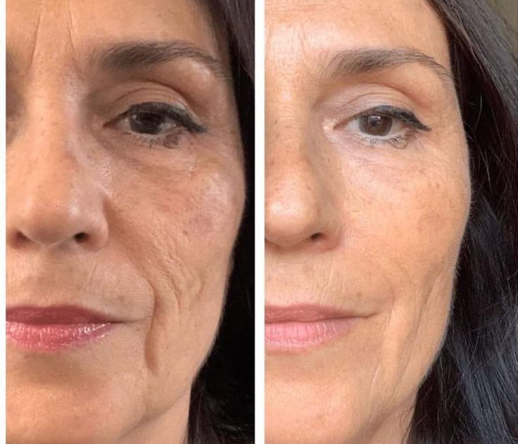 Before and after